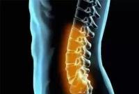 腰疼拍片子需要多少钱（腰痛需要拍片吗）