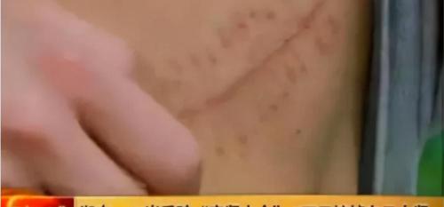 切肾手术多少钱（10年前卖肾买苹果手机的小伙）