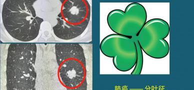 肺微创手术大概多少钱（从CT片上看肺癌结节）