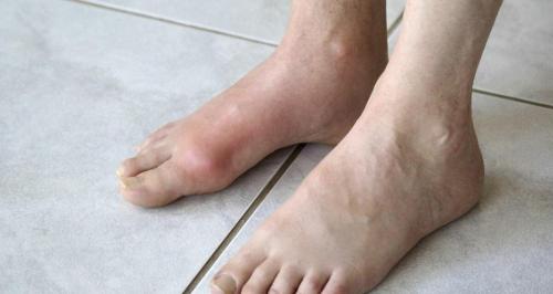 秋水仙碱多少钱一盒（得了痛风）