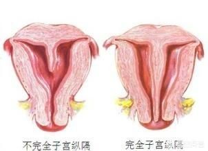 縱隔子宮手術多少錢（縱膈子宮不是疑難雜癥）