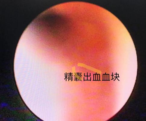 精囊镜检查多少钱（男科手术探秘6）