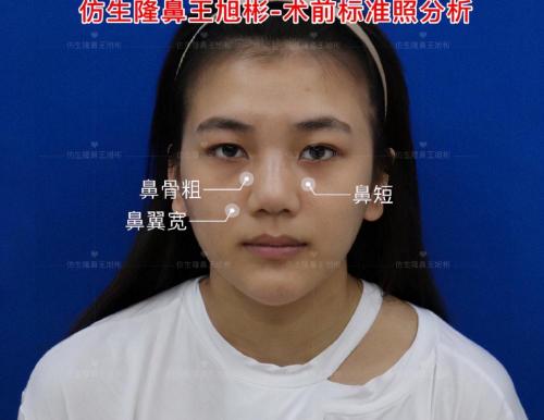 縮小鼻頭多少錢（大鼻頭毀了一張臉是什么體驗）