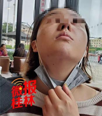 整容花多少钱（桂林女子花37000元整容）
