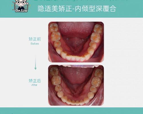 隐适美矫正价格（厦门牙齿矫正）