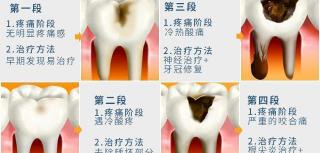 去除牙神经多少钱（抽完牙神经后）