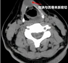 甲状腺激素检查多少钱（罕见）