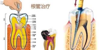 堵牙洞多少錢一顆（根管治療可以一次完成嗎）