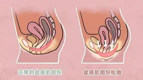 盆底肌做10次多少钱（你的盆底肌还好吗）