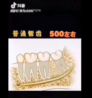 拔智齿拍片多少钱（埋得越深）