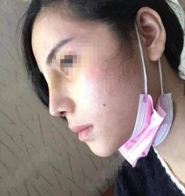 做隆鼻一般要多少钱（隆鼻失败了会怎样）