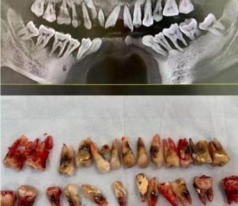 治疗牙周炎要花多少钱（无法保留）