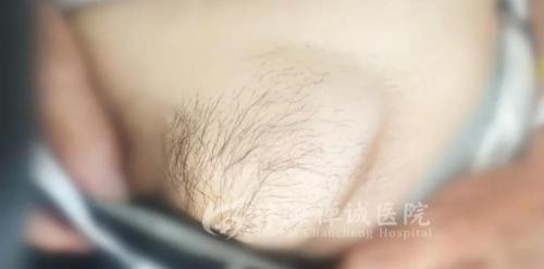 成人疝气手术要多少钱（转给爸妈）