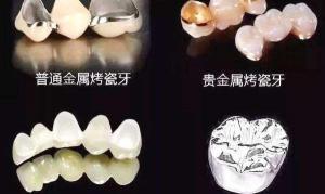 全瓷牙最便宜多少钱（很纠结）