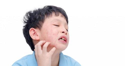 荨麻疹治疗需要多少钱（荨麻疹可以治愈吗）