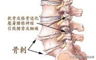 抗骨增生片多少钱一盒（骨质增生）