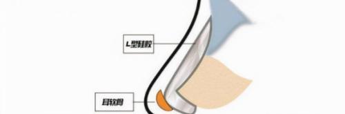 線雕綜合隆鼻多少錢（廣州鼻修復(fù)）