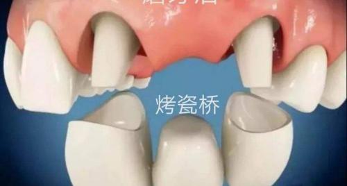 牙打桩多少钱（牙齿缺了）