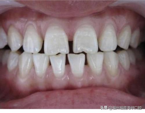 磨牙垫多少钱一副（牙缝大是什么征兆）