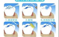 兒童牙齒窩溝封閉多少錢(qián)（做窩溝封閉的費(fèi)用是多少）