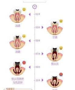 做牙齿根管治疗多少钱（根管治疗）