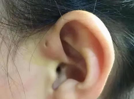 瘺管手術多少錢（寧死不造瘺）