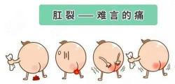 做肛裂手术多少钱（医生亲身和肛裂斗争的那些事）