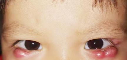 眼睛囊肿手术多少钱（1岁小女孩眼部连长多个脓包）
