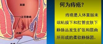 痔疮手术费多少钱（得了痔疮怎么办）