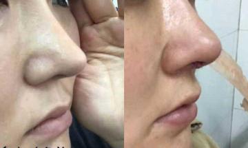 修复鼻子一般多少钱（柏伊美医疗美容门诊部）