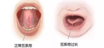 唇系帶手術多少錢（別讓這兩種系帶影響孩子的口腔健康）