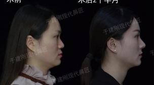 做玻尿酸隆鼻多少钱（4次玻尿酸隆鼻）