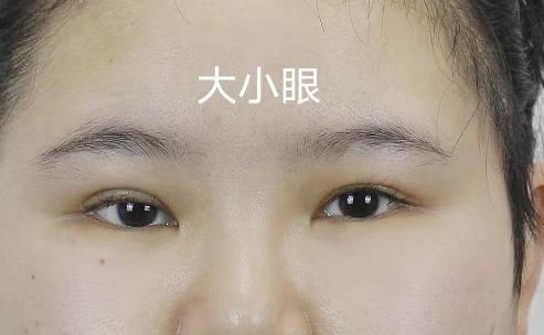 眼皮下垂手术费用多少钱（12月13日单侧上睑下垂修复）