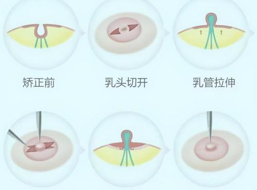 乳头内陷做手术一般多少钱（乳头内陷危害知多少）