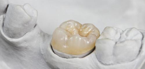牙齿做嵌体多少钱（嵌体修复跟传统补牙相比到底好在哪）