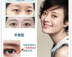 眼皮下垂手术费用多少钱（做双眼皮的时候）