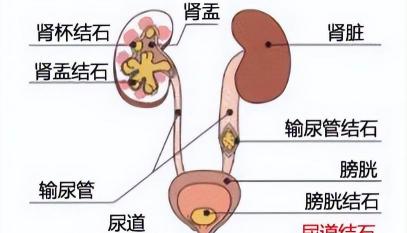 输尿管碎石一般多少钱（泌尿系结石）
