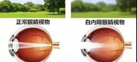 散光眼手术大概多少钱（散光型人工晶体）