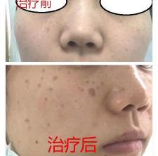 激光去皱一般多少钱（激光仪器）
