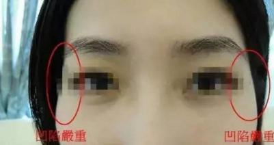填充太阳穴要多少钱（太阳穴凹陷显老显凶）