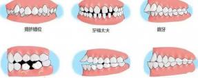 天包地矫正多少钱（做牙齿矫正）