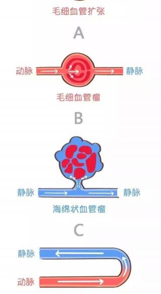 眼睛血管瘤手术多少钱（宝宝眼部有紫红色肿块）