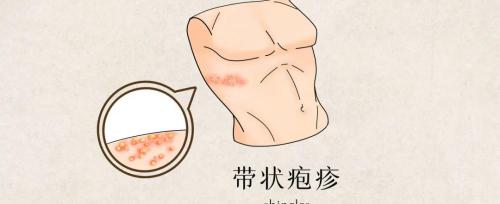 拉莫三嗪多少钱一盒（痛到怀疑人生的带状疱疹）