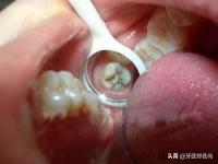 治疗蛀牙要多少钱（蛀牙经常疼怎么治）