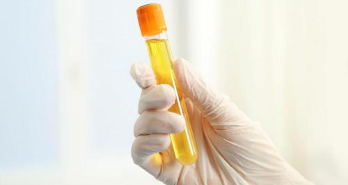检查尿酸要多少钱（我老公两次检查尿酸分别为460和510）