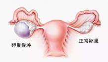 婦科囊腫手術(shù)多少錢（早衰）