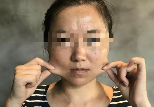 整形瘦脸要多少钱（女孩打了一针）