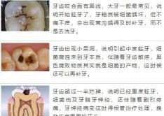 治疗蛀牙要多少钱（小洞不补大洞吃苦）