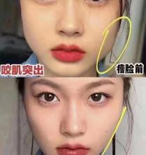 瘦咬肌多少钱一针（打瘦脸针效果好）