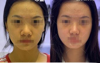 鼻部整形整容术多少钱（常见鼻整形项目案例合集）